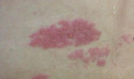 阑尾疼可以吃瓜吗,西瓜，甜蜜的禁忌？